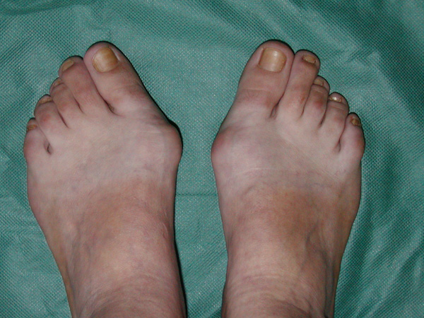 hallux-valgus-centre-orthop-dique-pasteur-lanroze